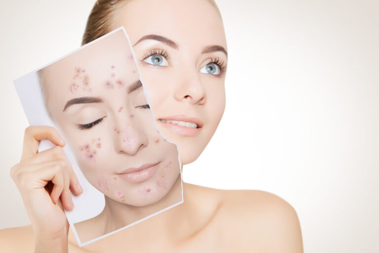 Acne: causes, treatment, prevention