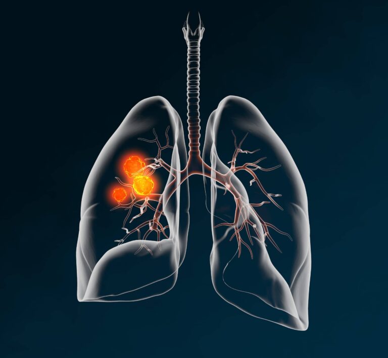 Lung cancer: risk factors, symptoms, treatment.